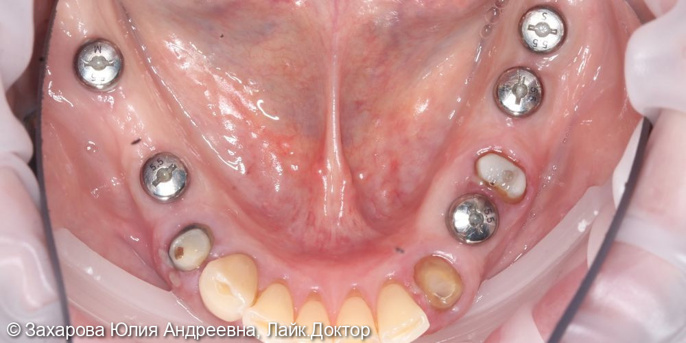 Протезирование с опорой на свои зубы и дентальные имплантаты - фото №1