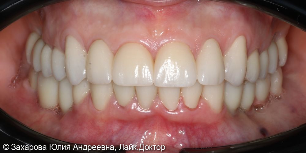 Протезирование с опорой на свои зубы и дентальные имплантаты - фото №2