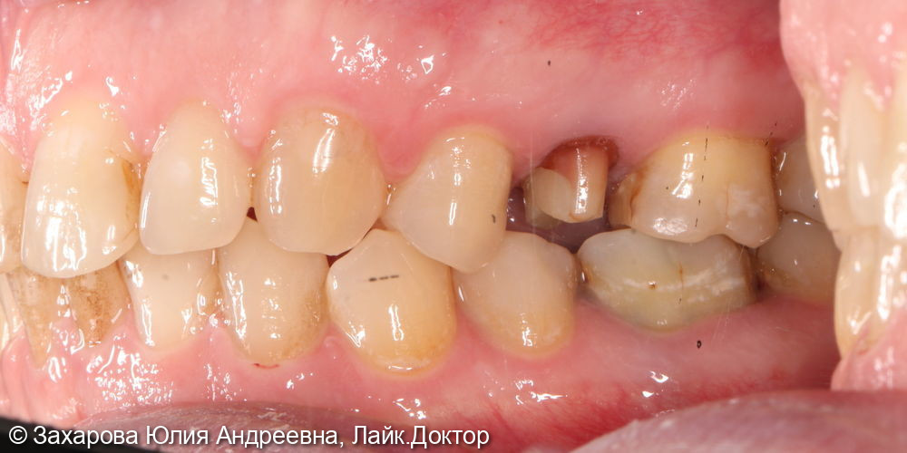 Протезирование с опорой на свой зуб - фото №1