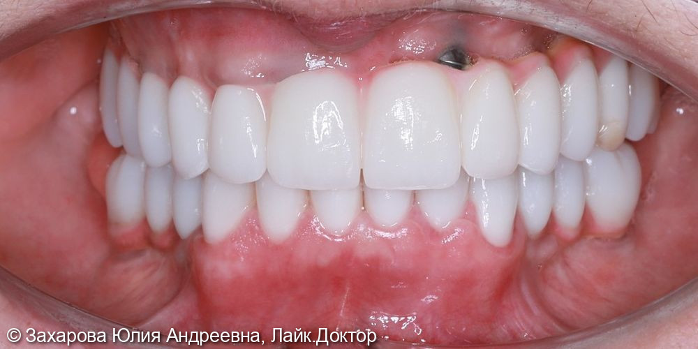 Протезирование с опорой на имплантаты и свои зубы - фото №5