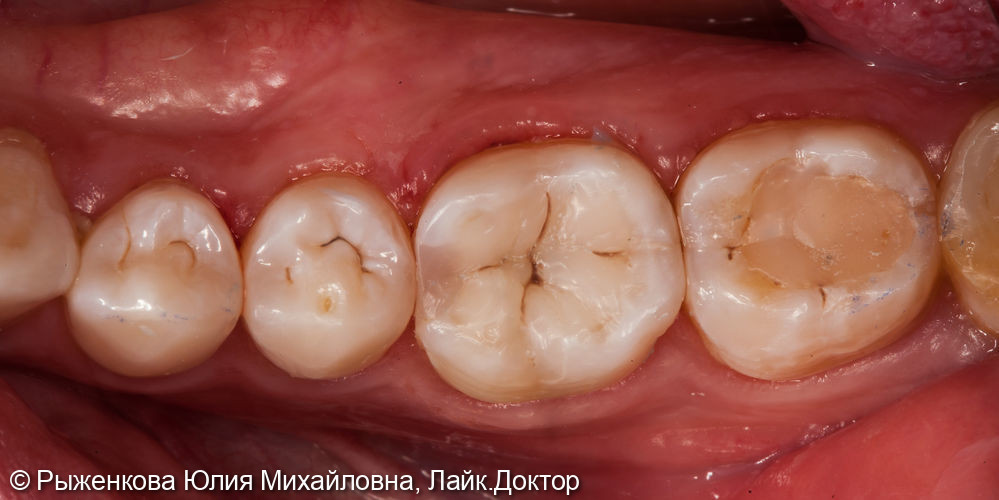 Лечение кариеса на жевательном зубе - фото №2
