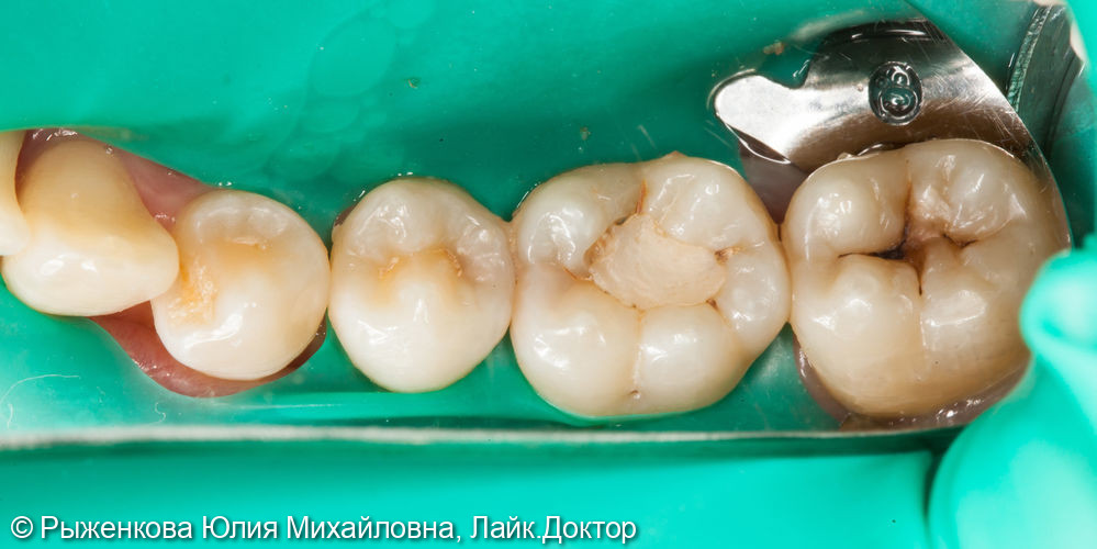 Лечение кариеса на контактных поверхностях 5 и 6 зубов - фото №1