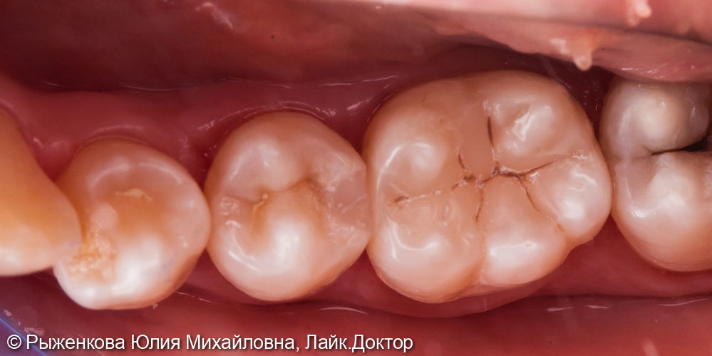 Лечение кариеса на контактных поверхностях 5 и 6 зубов - фото №3