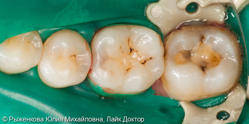 Лечение кариеса на 7 зубе - фото №1