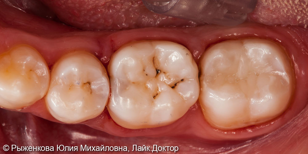 Лечение кариеса на 7 зубе - фото №3