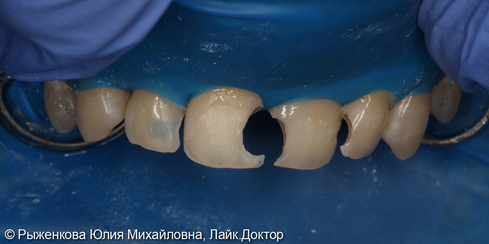 Лечение кариеса на передних зубах, подготовка к элайнерам - фото №1