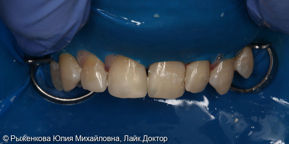 Лечение кариеса на передних зубах, подготовка к элайнерам - фото №4