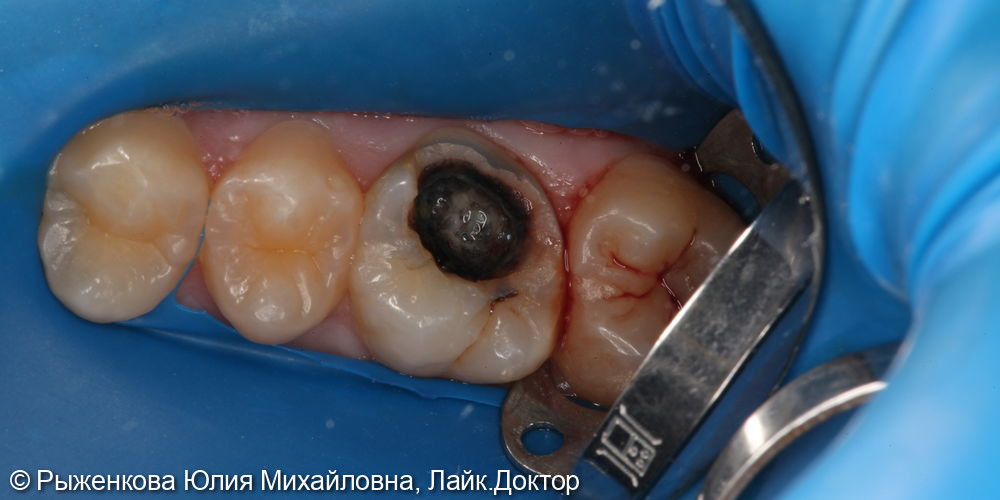 Лечение пульпита в верхнем коренном зубе - фото №1
