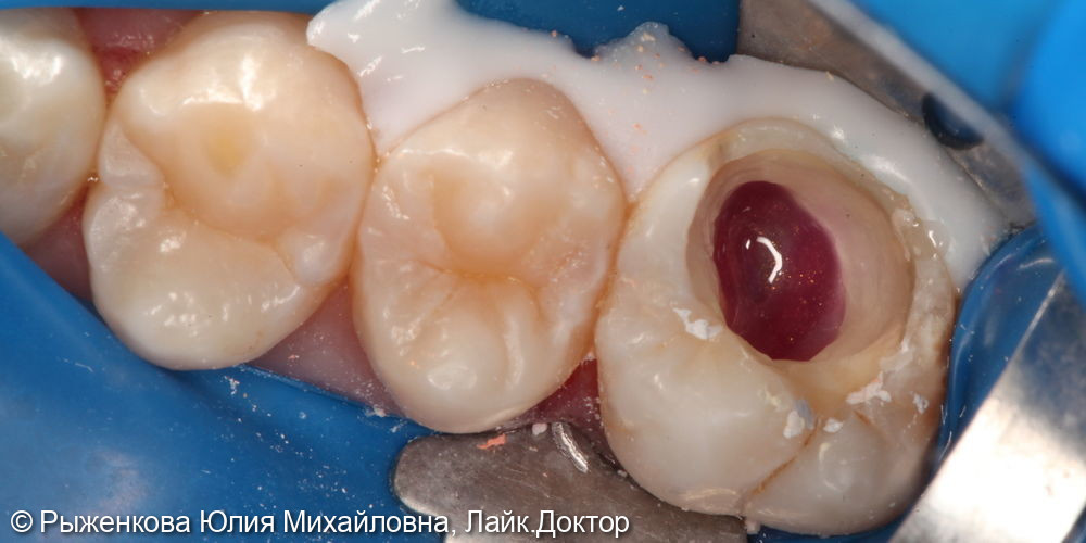 Лечение пульпита в верхнем коренном зубе - фото №4