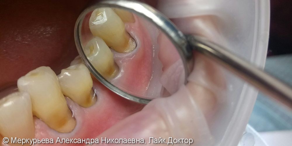 Лечение клиновидного дефекта зуба - фото №1