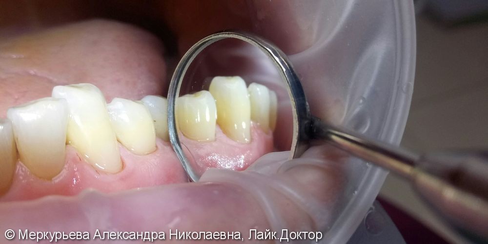 Лечение клиновидного дефекта зуба - фото №2