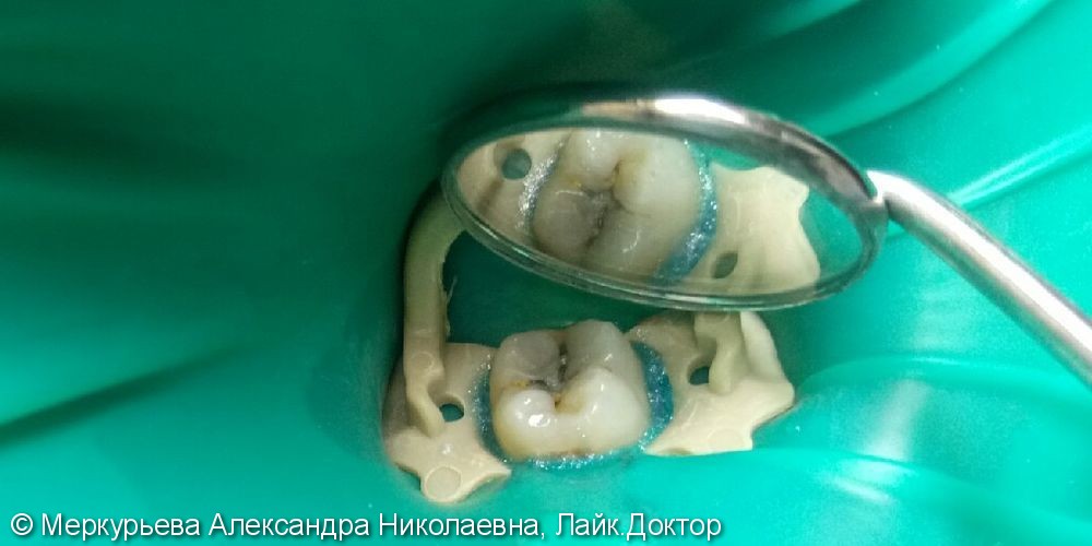 Лечение глубокого кариеса зуба 47 - фото №1