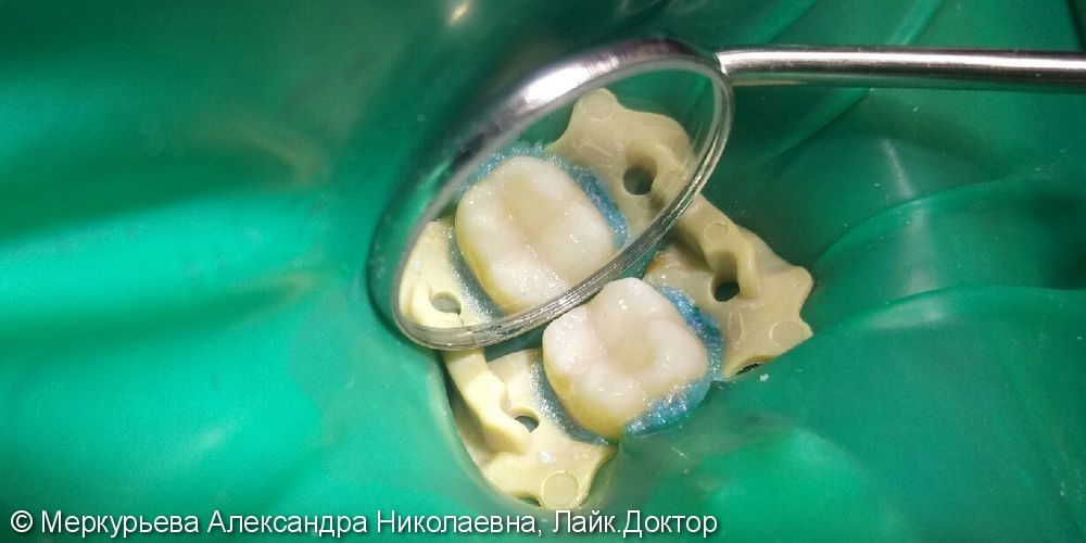 Лечение глубокого кариеса зуба 47 - фото №3