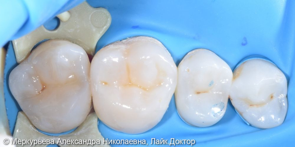 Лечение глубокого кариеса в зубах 26,27 - фото №3