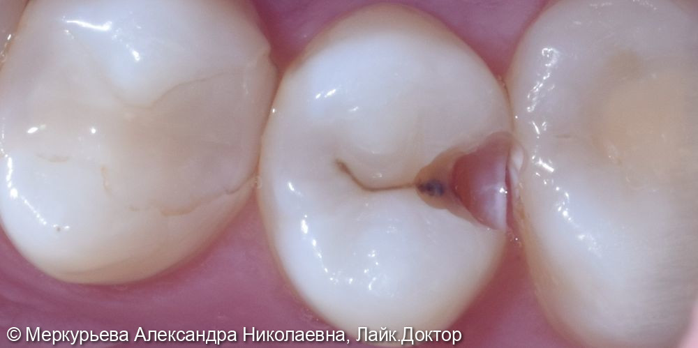 Лечение глубокого кариеса в зубе 15 - фото №1