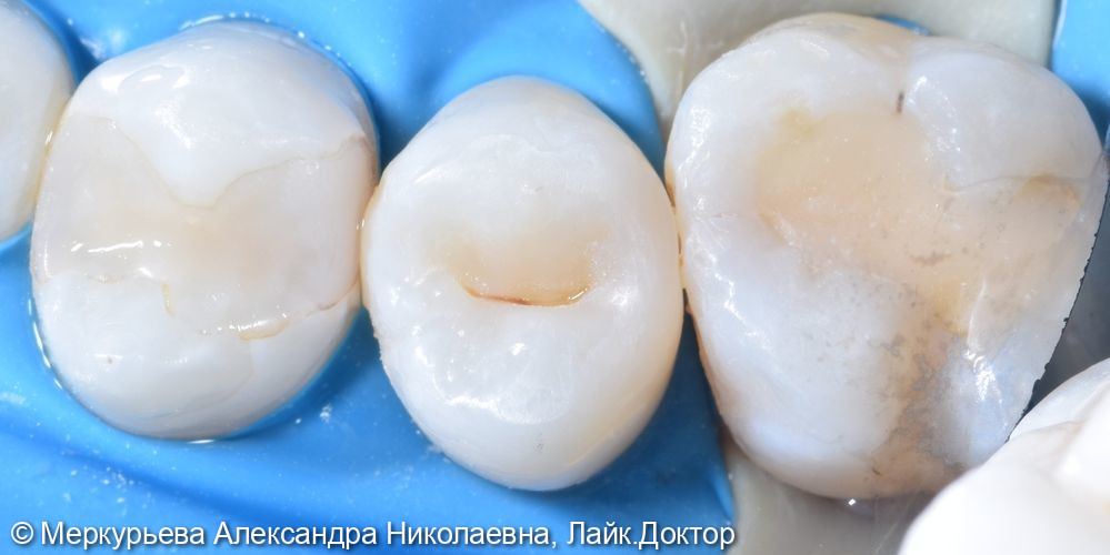 Лечение глубокого кариеса в зубе 15 - фото №3