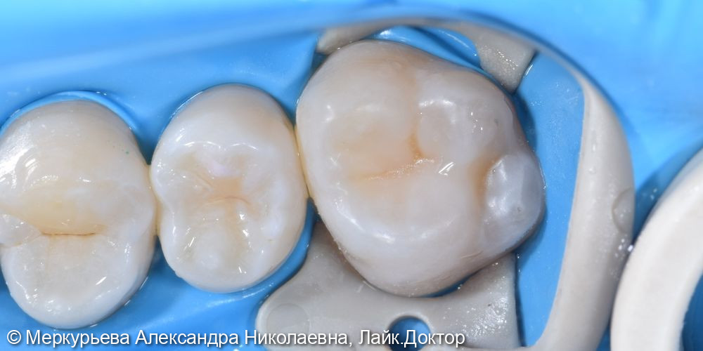 Лечение глубокого кариеса зуба 16 - фото №2