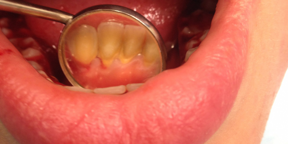 Жалобы на наличие зубных отложений и кровоточивость десен - фото №1