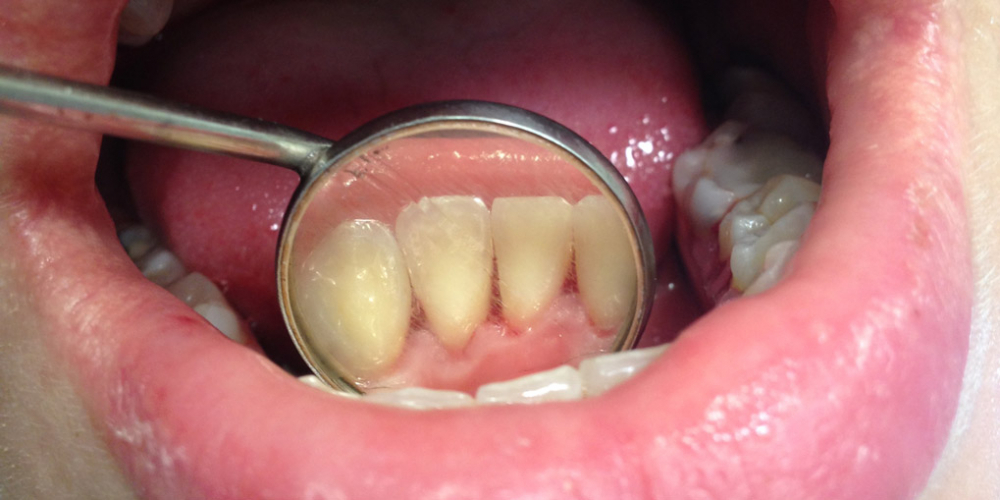 Жалобы на наличие зубных отложений и кровоточивость десен - фото №2