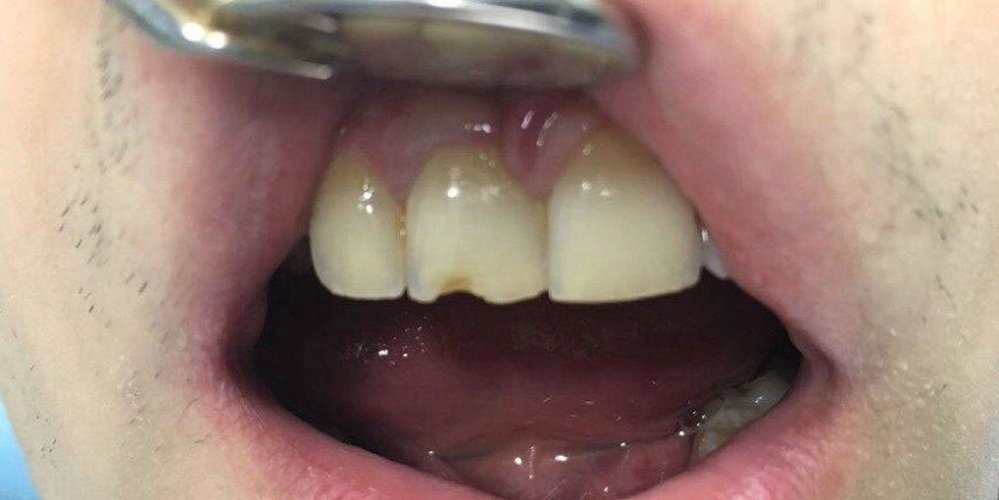 Восстановление скола зуба композиционным материалом - фото №1