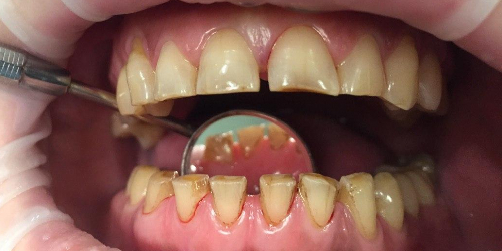 Профессиональная гигиена полости рта, результат до и после чистки - фото №1