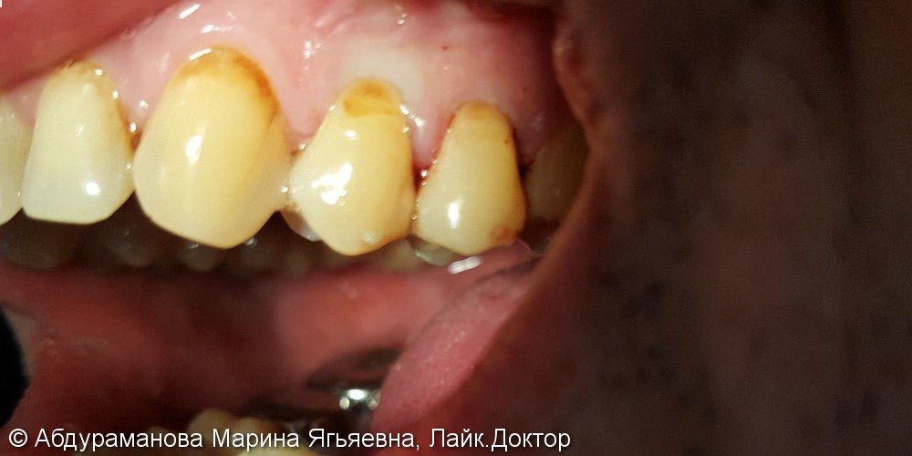 Фото до и после восстановление клиновидных дефектов двух зубов - фото №1