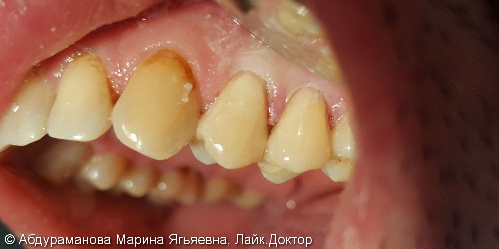 Фото до и после восстановление клиновидных дефектов двух зубов - фото №2