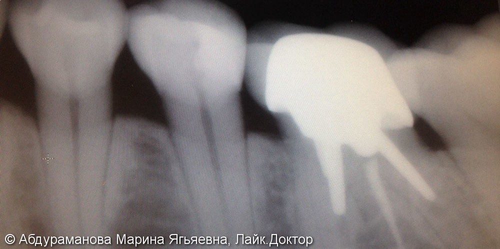 Жалобы на боли в зубе от холодного, ночные самопроизвольные боли - фото №1