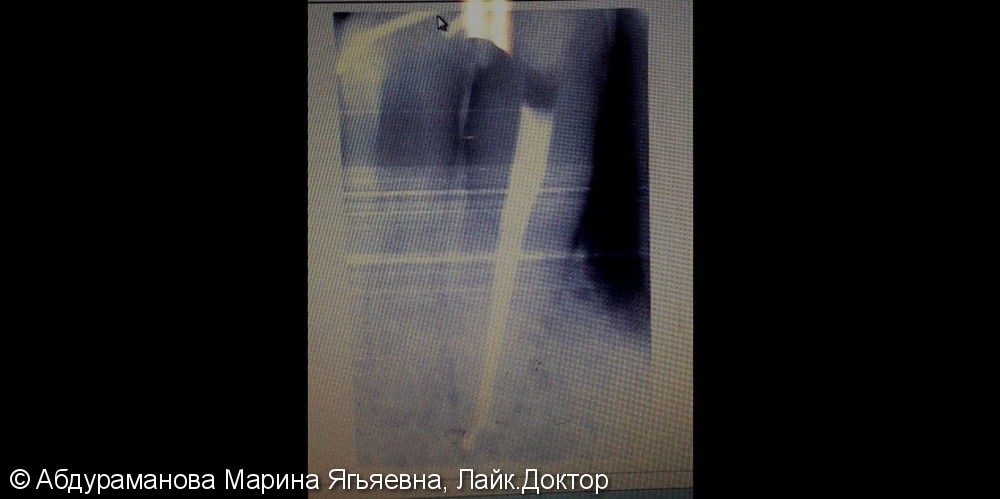 Эндодонтическое лечение зуба 4.3 - фото №2