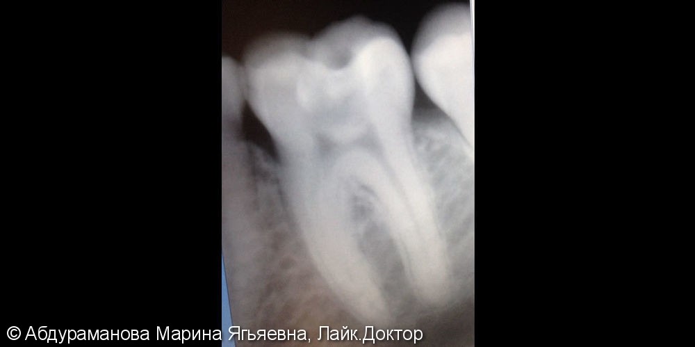 Эндодонтическое лечение зуба 3.6 при обострении хронического периодонтита - фото №1