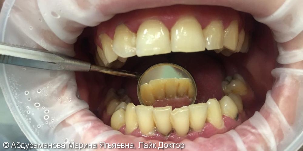 Удаление над- и поддесневых зубных отложений с помощью ультразвукового аппарата - фото №1