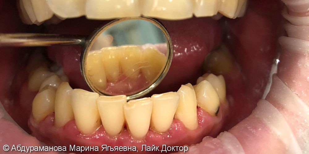 Удаление над- и поддесневых зубных отложений с помощью ультразвукового аппарата - фото №2
