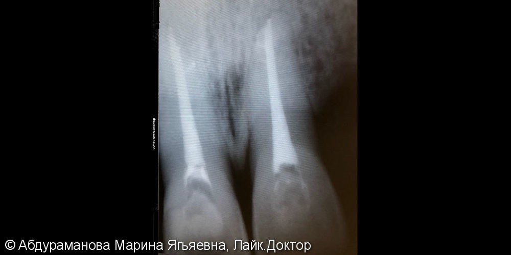 Эндодонтическое лечение зубов 1.1, 2.1 - фото №2