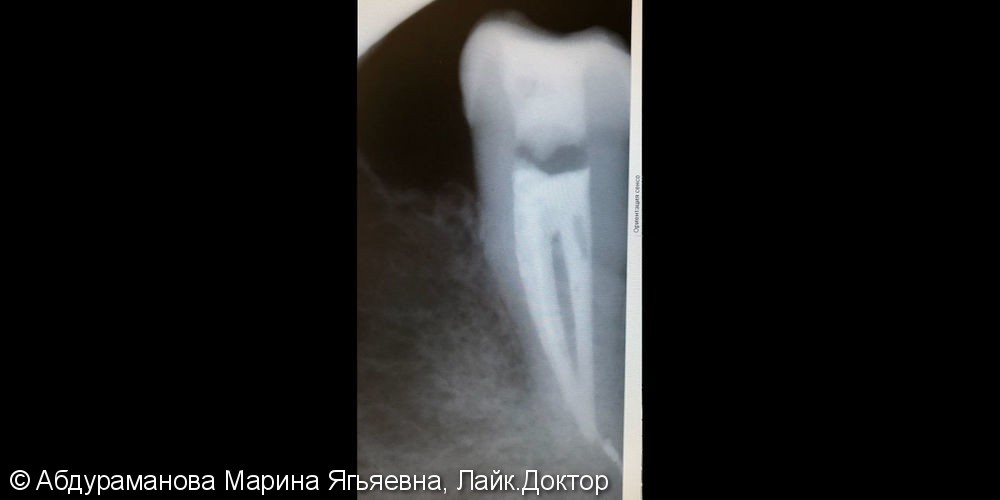 Эндодонтическое лечение зуба 3.7 - фото №2