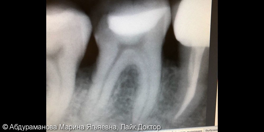 Эндодонтическое лечение зуба 4.6 - фото №1