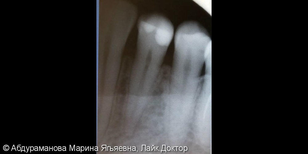 Эндодонтическое лечение зуба при обострении хронического периодонтита - фото №1
