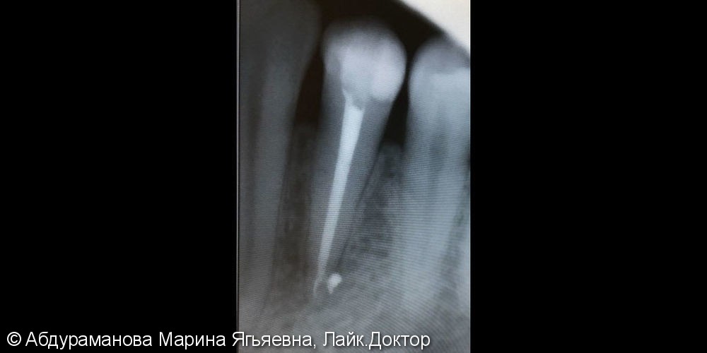 Эндодонтическое лечение зуба при обострении хронического периодонтита - фото №2