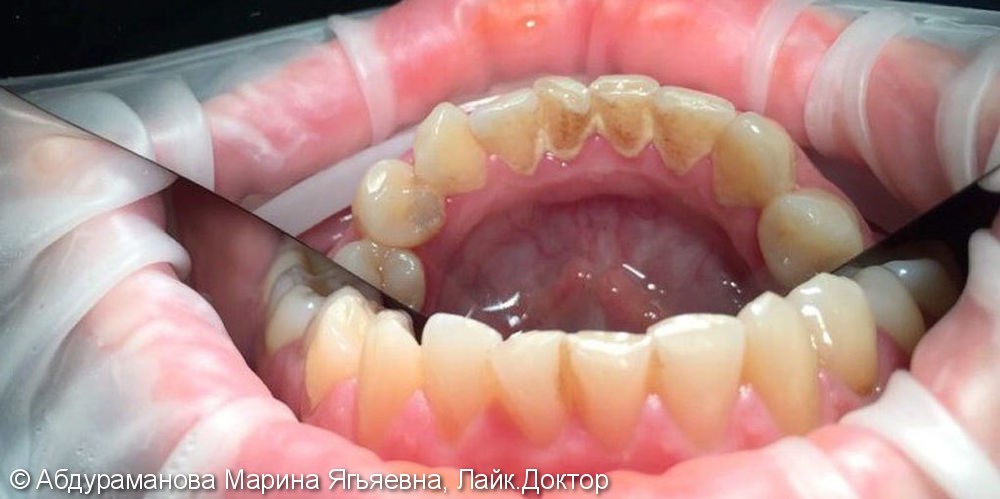 Наличие зубных отложений и кровоточивость десен во время чистки зубов - фото №1