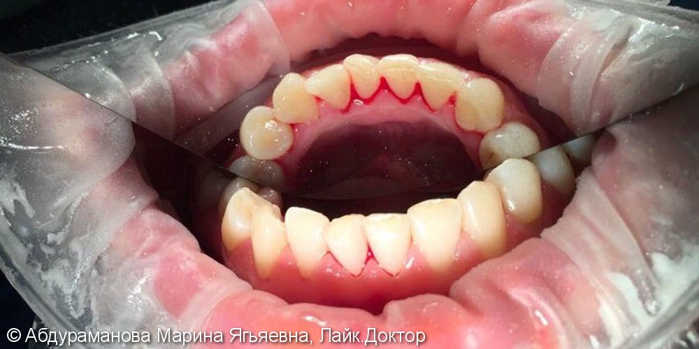 Наличие зубных отложений и кровоточивость десен во время чистки зубов - фото №2