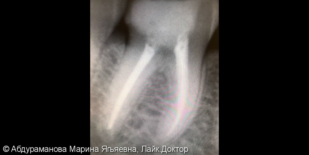 Эндодонтическое лечение зуба 4.6 - фото №2