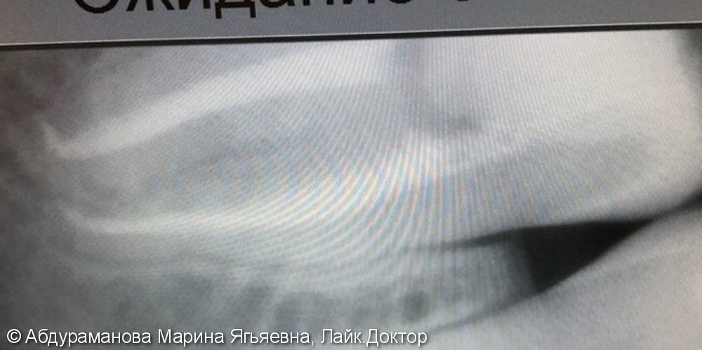 Эндодонтическое лечение зуба 4.7 с применением коффердама - фото №2