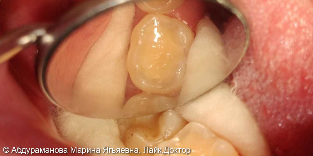 Хронический глубокий кариес зуб 3.6 - фото №2