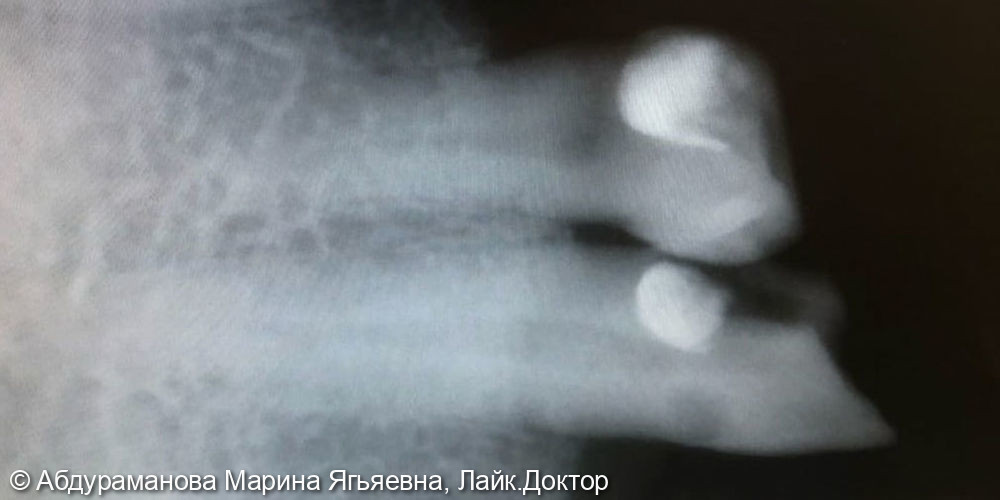 Эндодонтическое лечение двух зубов 4.3, 4.4 - фото №1