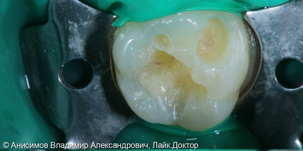 Лечение кариеса зуб 2.6 - фото №1