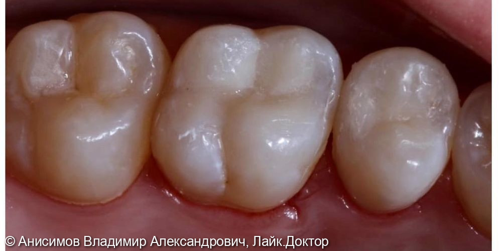 Лечение кариеса зуб 1.6, 1.5 - фото №3