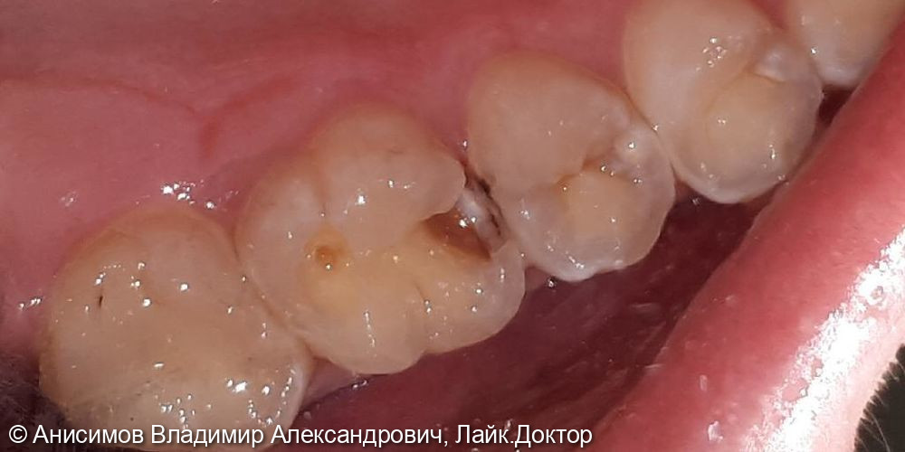 лечение кариеса зуб 2.5, 2.6 - фото №1