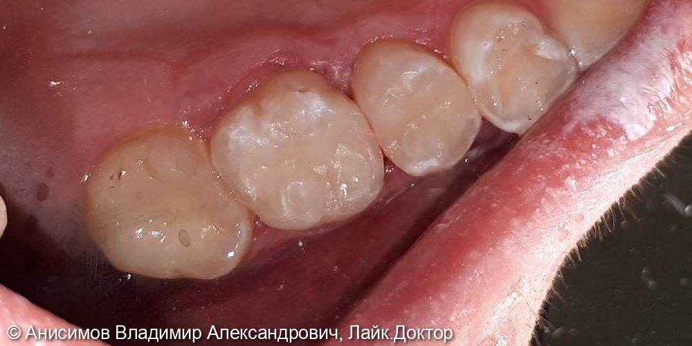 лечение кариеса зуб 2.5, 2.6 - фото №2