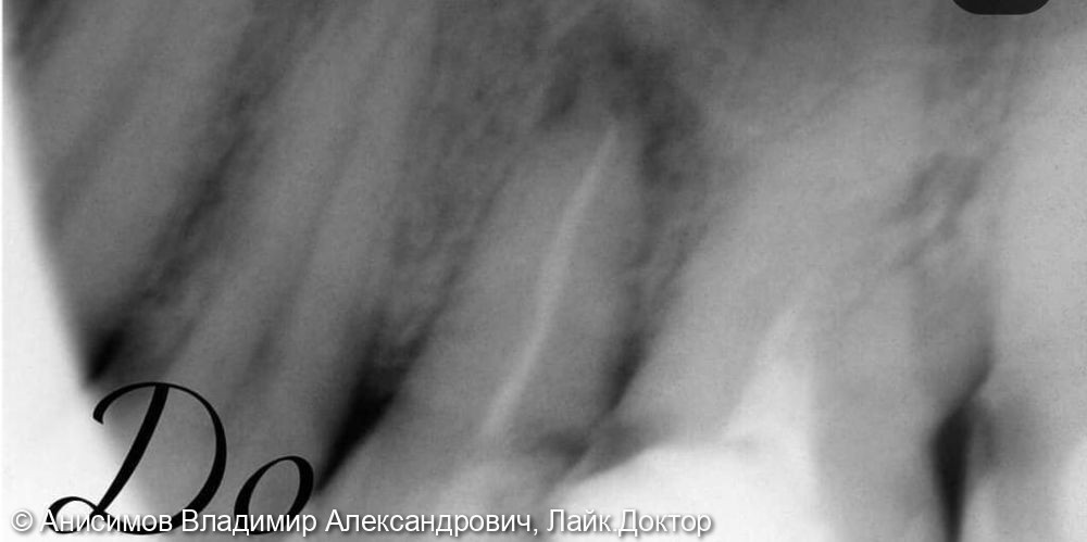 лечение апикального периодонтита зуб 2.5 - фото №1
