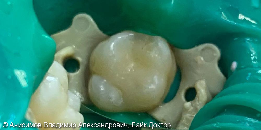 Лечение кариеса зуб 1.6 - фото №4