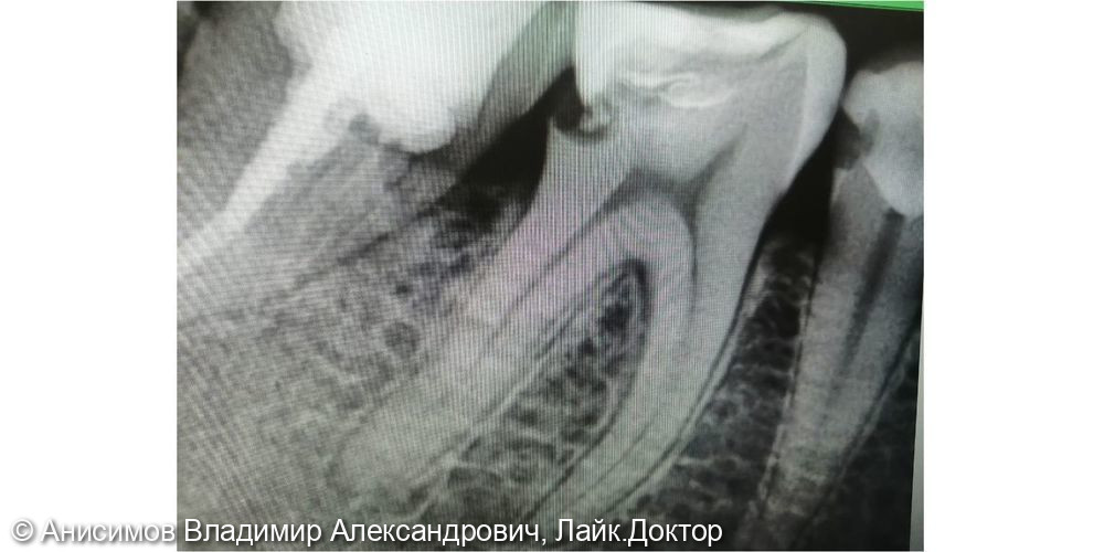 Лечение пульпита зуб 3.6 - фото №1